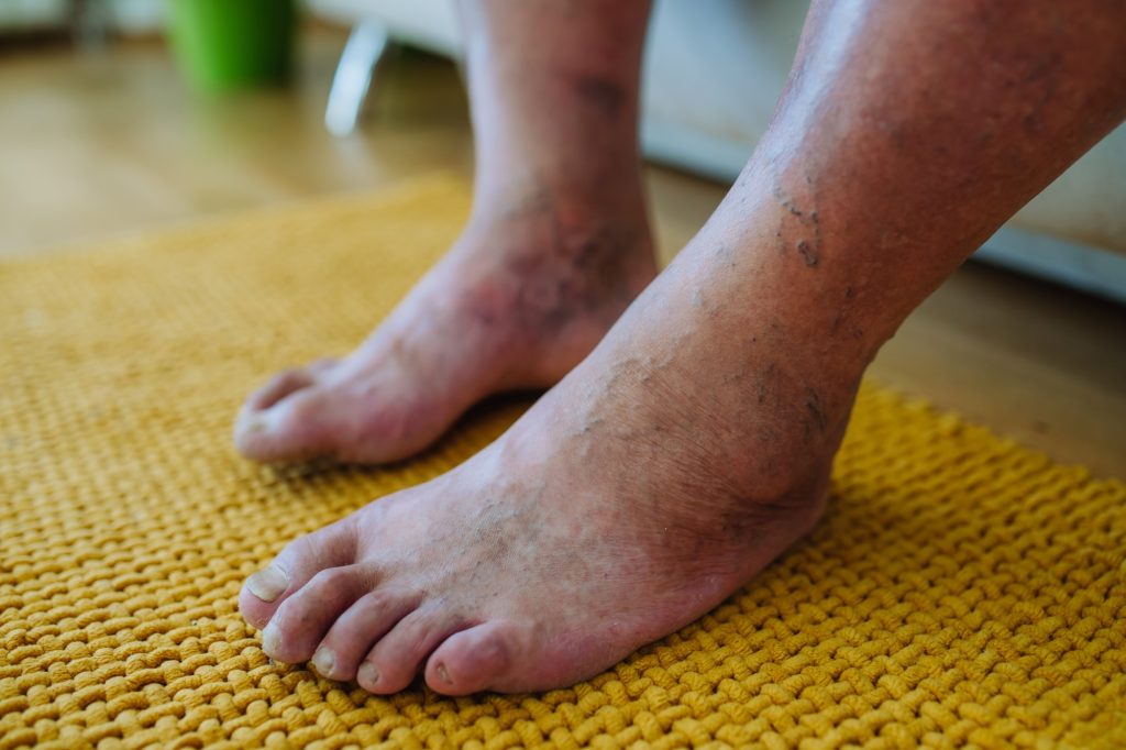 A close-up shot of man's feet with diabetic foot complications.